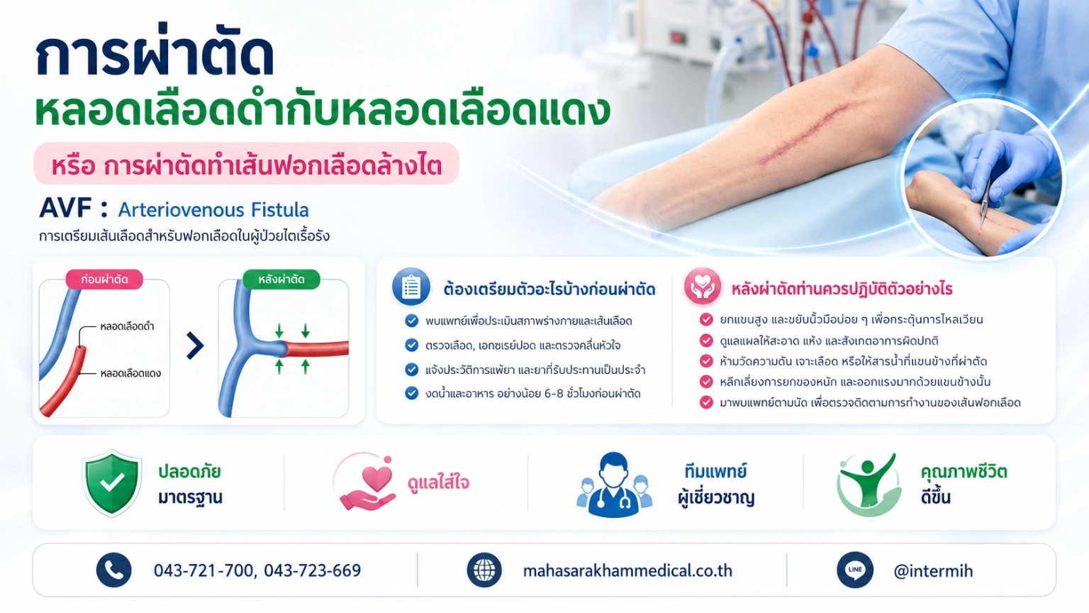 การผ่าตัดหลอดเลือดดำกับหลอดเลือดแดง (AVF)