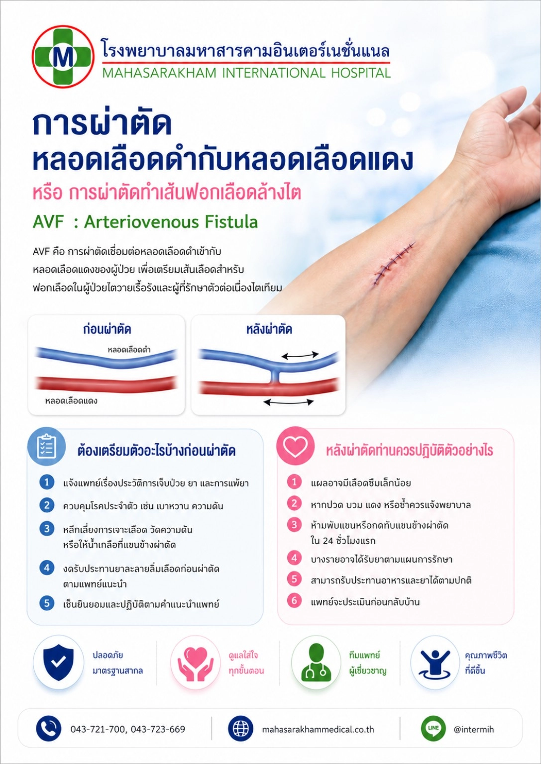 การผ่าตัดหลอดเลือดดำกับหลอดเลือดแดง (AVF)